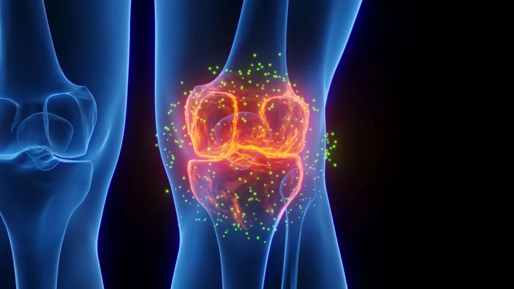 3d-knee-joint-inflammation-osteoarthritis